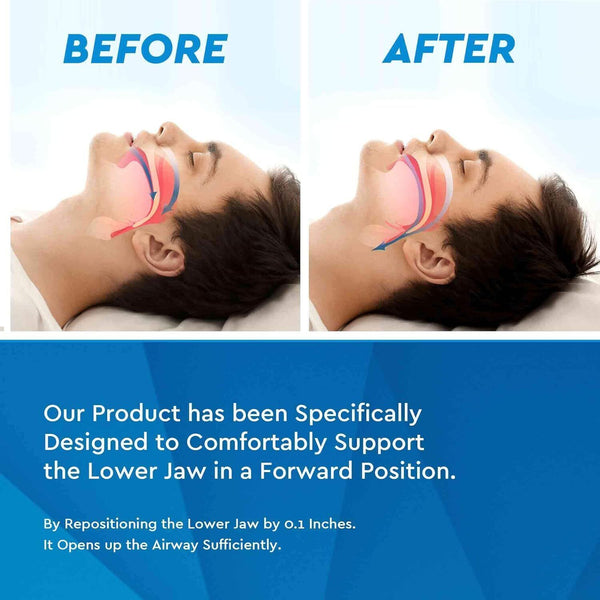 Neomen Anti Snoring Device  Custom Mouthpiece Snore Stopper for Men & Women